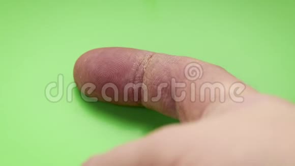 手部护理干燥的皮肤食指指骨上的裂缝视频的预览图