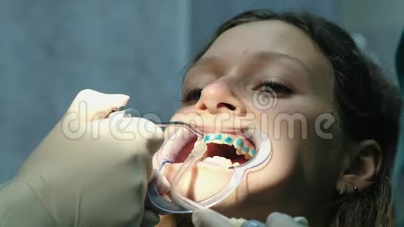 正畸医生在安装支架系统特写之前从牙齿上清洗特殊的蓝色凝胶访问视频的预览图