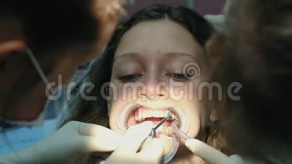 正畸医生在安装支架系统特写之前从牙齿上清洗特殊的蓝色凝胶访问视频的预览图