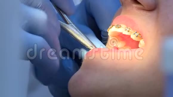 做病人牙套的牙医视频的预览图