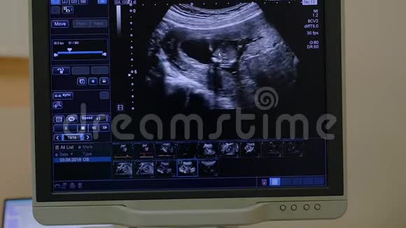 超声超声妊娠扫描第2胎婴儿胎儿视频的预览图