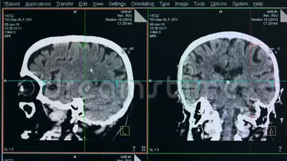 显示器上显示的脑部扫描过程视频的预览图