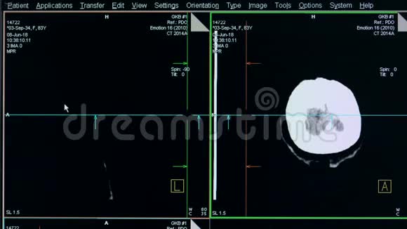 在扫描监视器上显示了对人脑病例的描述视频的预览图