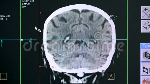 关闭在扫描过程中显示的脑壳视频的预览图