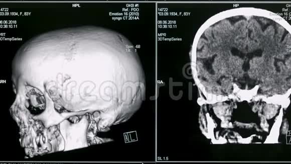 3显示器上显示的人脑病例D模型视频的预览图