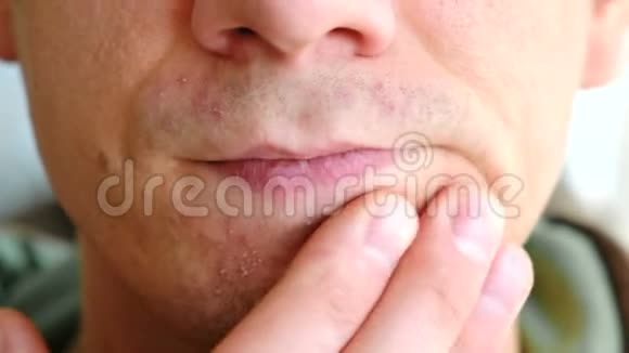 剃须后皮肤刺激男人抓着胳膊在下巴上疙瘩鼻子嘴唇和下巴的特写视频的预览图