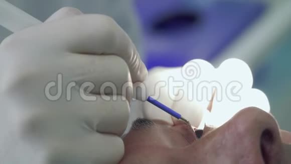 皮肤科医生用激光在人眼皮上灼烧痣视频的预览图
