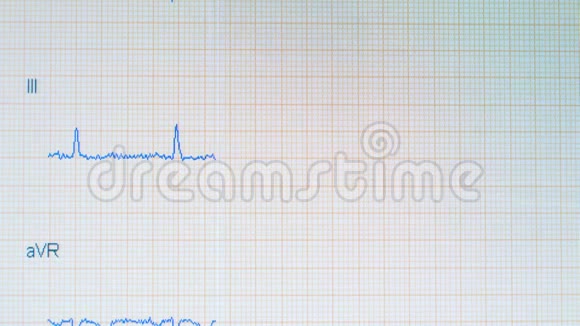 心电图心电监护仪显示心脏跳动正常视频的预览图