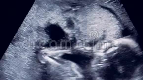 接近在母亲子宫里翻滚人类胎儿视频的预览图