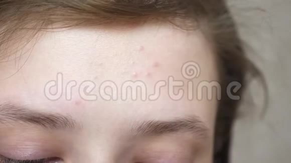 女孩用餐巾擦她的额头特写镜头青少年化妆品程序少女使用保湿剂视频的预览图