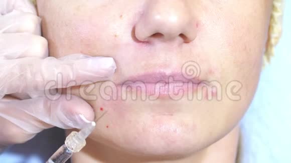 女性注射面部接受面部治疗临床整形外科填充剂注射器视频的预览图