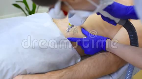 美容医生移除纹身病人专业激光视频的预览图