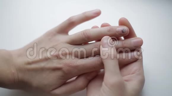 病钉上的瘀伤职业创伤不健康受损手指指甲女孩检查指甲异常视频的预览图