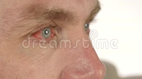 常见眼部感染及炎症男士滴剂治疗滴剂4K视频的预览图