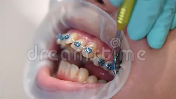 牙医用Braces检查牙齿视频的预览图