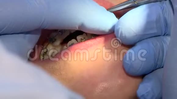 牙医在病人支架上更换橡胶视频的预览图