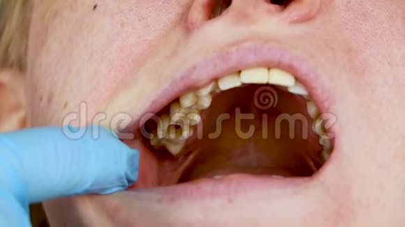 牙洞及牙管治疗牙周炎的治疗视频的预览图