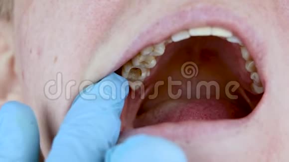 牙洞及牙管治疗牙周炎的治疗视频的预览图