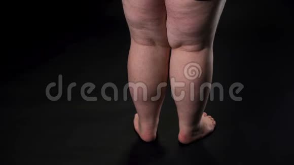 肥胖的男性腿有下垂的皮肤和纤维素过量的食物摄入保健视频的预览图