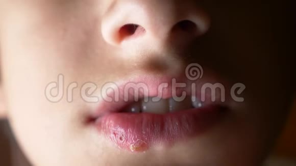一个男孩嘴唇上的疱疹疱疹嘴唇治疗4k慢镜头拍摄复制空间视频的预览图