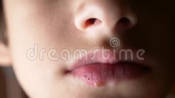 一个男孩嘴唇上的疱疹疱疹嘴唇治疗4k慢镜头拍摄复制空间视频的预览图