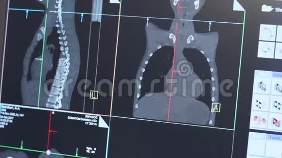 监视器上人体磁共振图像CT扫描专家视频的预览图