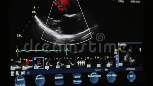 医生检查病人心脏超声心动图视频的预览图