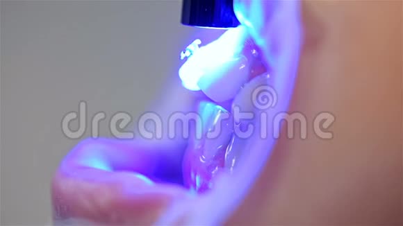 牙医安装病人支架视频的预览图