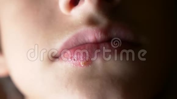 一个男孩嘴唇上的疱疹疱疹唇部治疗4k慢镜头拍摄复制空间视频的预览图