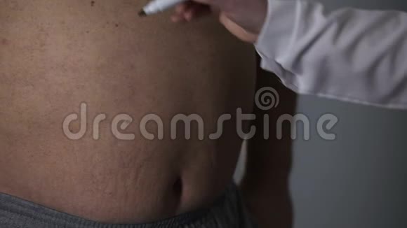 整形外科医生在超重肥胖的男性大肚子上划切口线视频的预览图