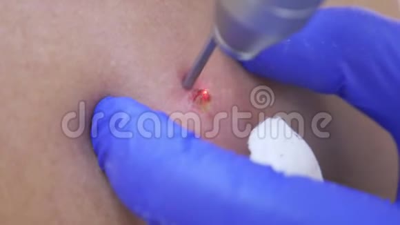 皮肤性病医生用激光束在一个男人的背上烧伤一个胎记4k特写慢动作视频的预览图