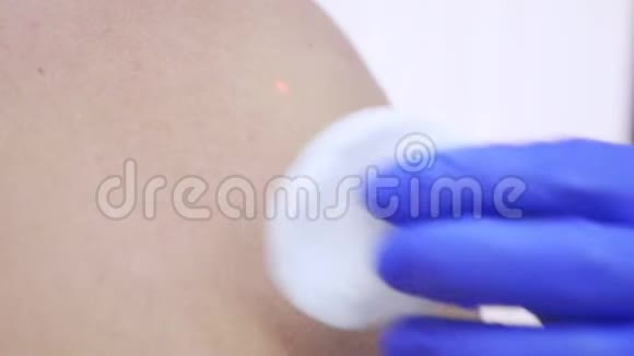 皮肤性病医生用激光束在一个男人的背上烧伤一个胎记4k特写慢动作视频的预览图
