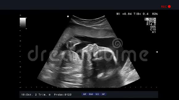 超声检查胎儿在子宫里视频的预览图
