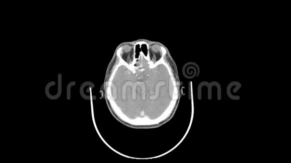 上颈顶视平滑运动CT扫描视频的预览图