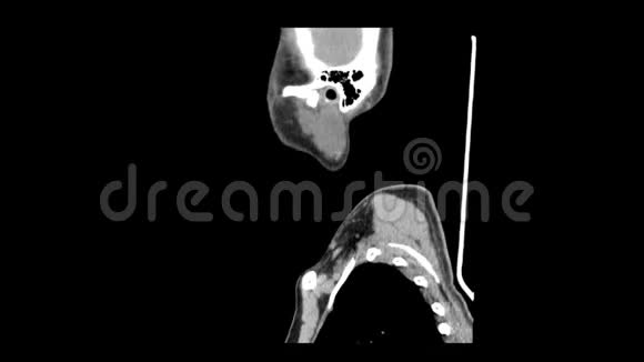 颈部侧视平滑运动CT扫描视频的预览图
