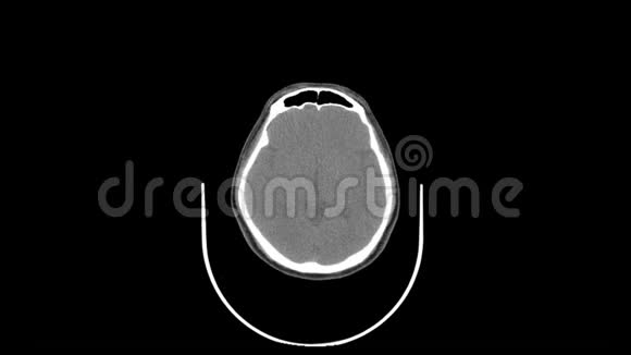 上颈顶视平滑运动CT扫描视频的预览图