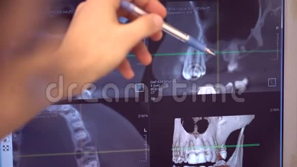 牙齿的X光全景图片和牙医用工具的手在屏幕上移动视频的预览图