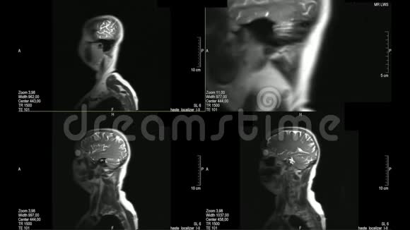 医生检查脑和胸椎的真实MRI扫描视频的预览图