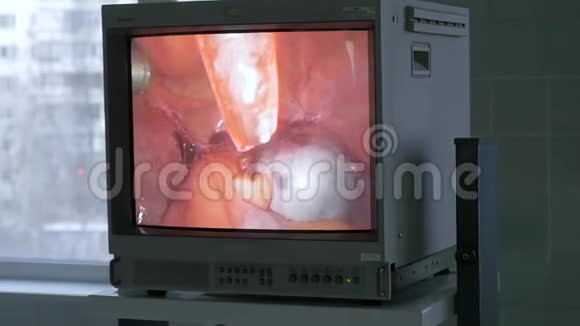 视频操作在监视器上广播医生用特殊的机械手工作视频的预览图