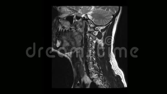 骨软骨病患者颈椎MRI计算机断层扫描视频的预览图
