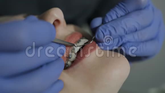 矫正手在牙套上戴上弹性健康的牙齿病人的微笑很好视频的预览图