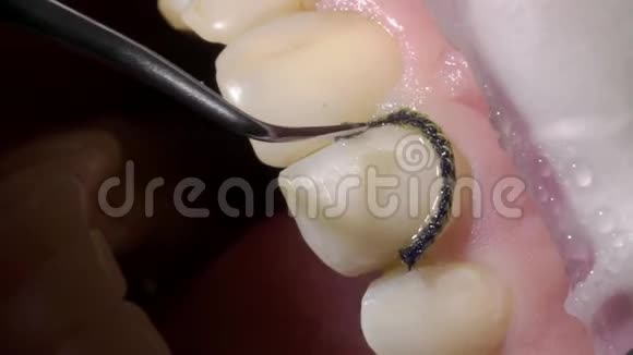 牙科医生做牙科整形视频的预览图