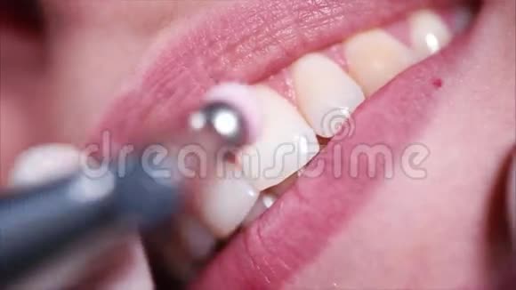 一个正在刷牙的女人嘴的特写镜头牙医帮她刷牙视频的预览图