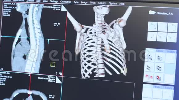 监视器上人体肋骨的断层扫描高技术放射线视频的预览图