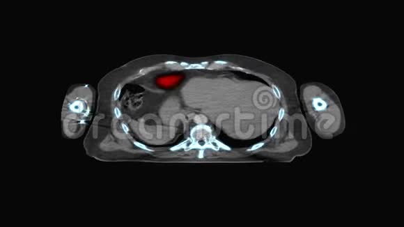 医学MRI扫描屏幕CT或CAT扫描仪图像视频的预览图