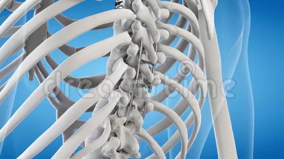 一种脊柱植入物视频的预览图