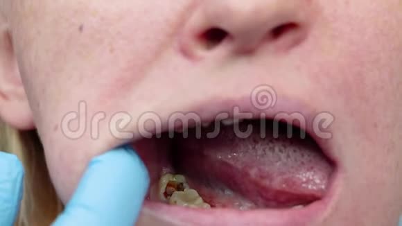深龋开渠清渠入院时患口腔炎牙周炎治疗视频的预览图