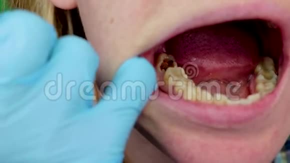 深龋开渠清渠入院时患口腔炎牙周炎治疗视频的预览图