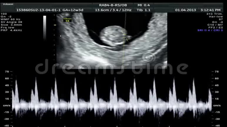 婴儿超声波扫描视频的预览图