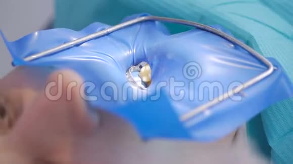 牙医在现代牙科诊所治疗病人作业采用围堰进行视频的预览图